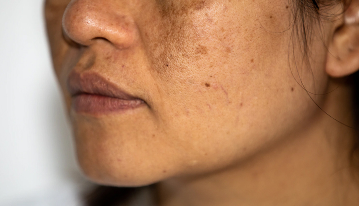 apple cider vinegar,beauty benefits of apple cider vinegar,apple cider vinegar for skin,skin care tips,beauty tips