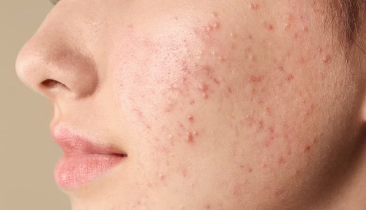 apple cider vinegar,ways to use apple cider vinegar,beauty benefits of apple cider vinegar,beauty tips,skin care tips