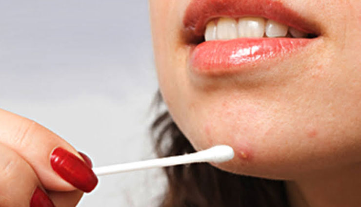 5 Different Ways To Treat Acne with Apple Cider Vinegar