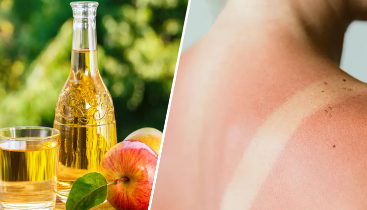 Can You Use Apple Cider Vinegar For Sunburn?