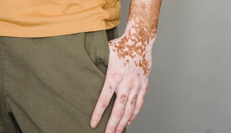 apricots,health benefits of apricots,Health tips,fitness tips