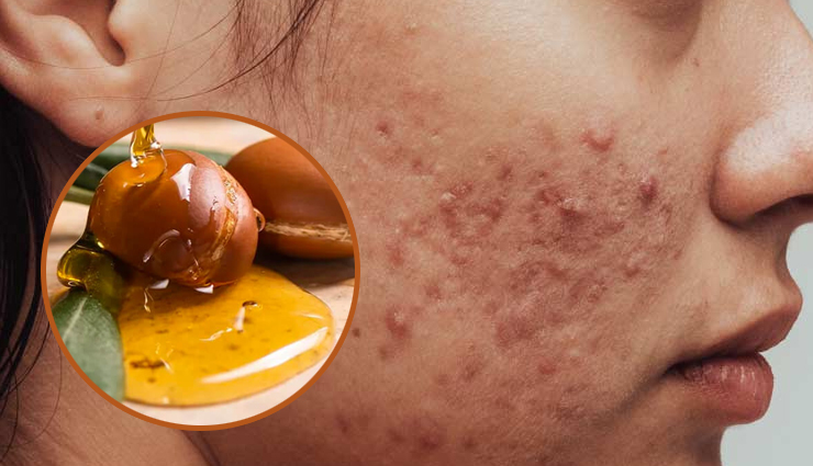 6 Argan Oil Face Packs for Clear and Acne-Free Skin