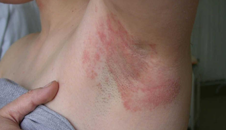 major causes of itchy armpits,beauty tips,beauty hacks