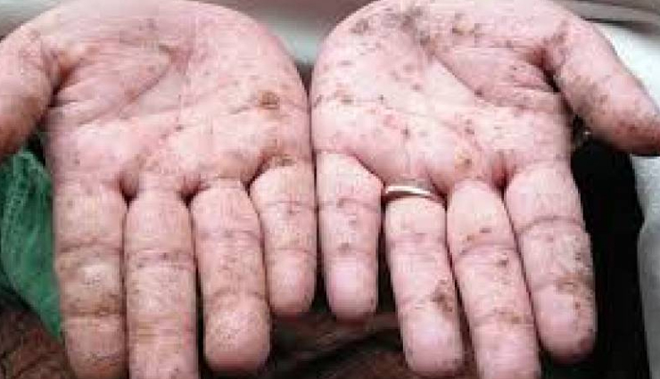 disease you can smell,10 fascinating diseases that you can smell,disease,diabetic ketoacidosis,maple syrup urine disease,Migraine,arsenic poisoning,phenylketonuria,typhoid fever,narcolepsy,bacterial infection,schizophrenia,parkinsons disease,Health,Health tips