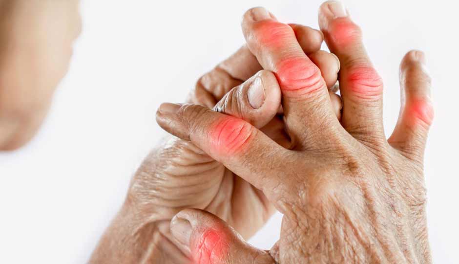 15 Effective Home Remedies to Manage Arthritis Naturally