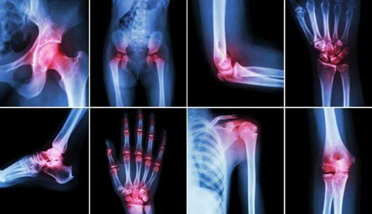 apple cider vinegar,apple cider vinegar benefits,bacteria,arthritis pain,assists weight loss,treats polycystic ovary syndrome,reduces bad cholesterol,controls blood sugar levels,Health,health benefits