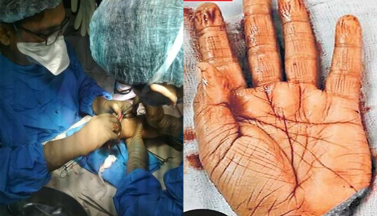 डॉक्टरों ने किया कमाल, साढ़े 7 घंटे की सर्जरी के बाद जोड़ा ASI का कटा हाथ
