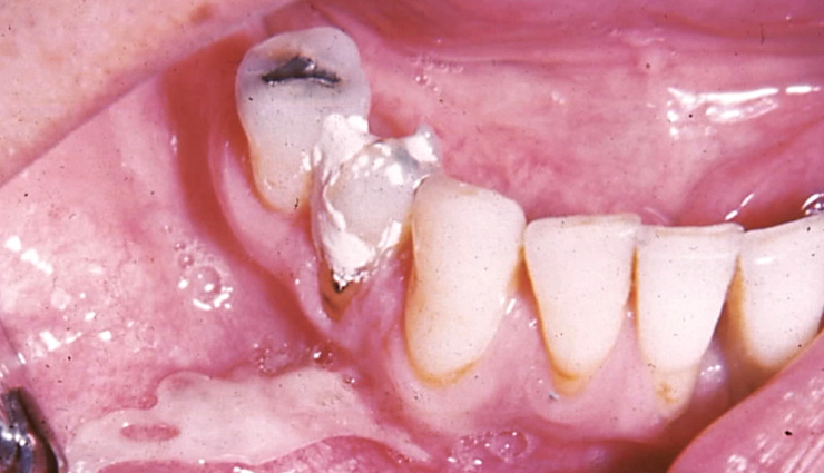 common mouth problems,tongue issues,dental hygiene,oral health concerns,mouth and tongue conditions,dental caries prevention,periodontal disease prevention,amalgam tattoo,halitosis treatment,black hairy tongue causes,canker sore remedies,tooth decay prevention,tooth abscess treatment,cold sore management,chipped tooth repair,leukoplakia diagnosis,lichen planus symptoms,thrush treatment,oral cancer detection,dry mouth remedies