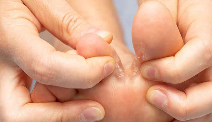 home remedies,home remedies to treat athletes foot,athletes foot remedies,Health tips,fitness tips,summer tips