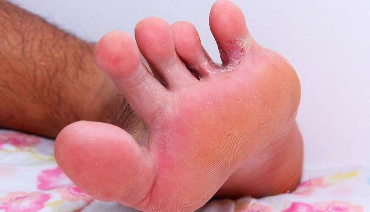 Use These Home Remedies To Fight The Fungus That Causes Athletes Foot