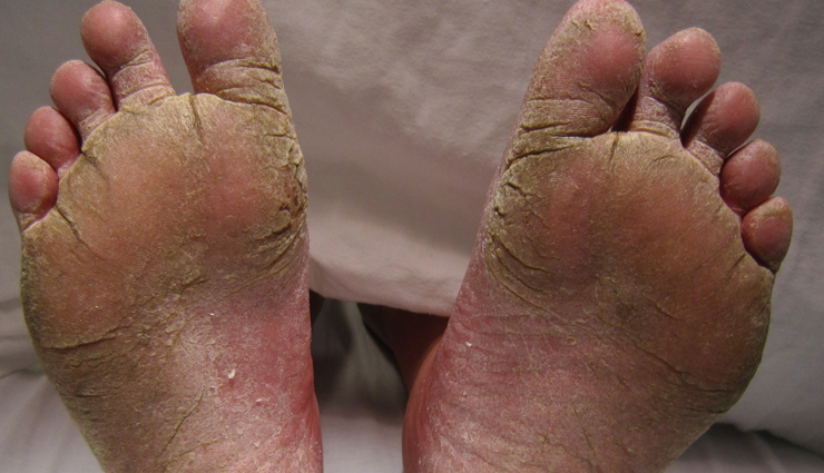 6 Effective Home Remedies To Treat Athlete's Foot