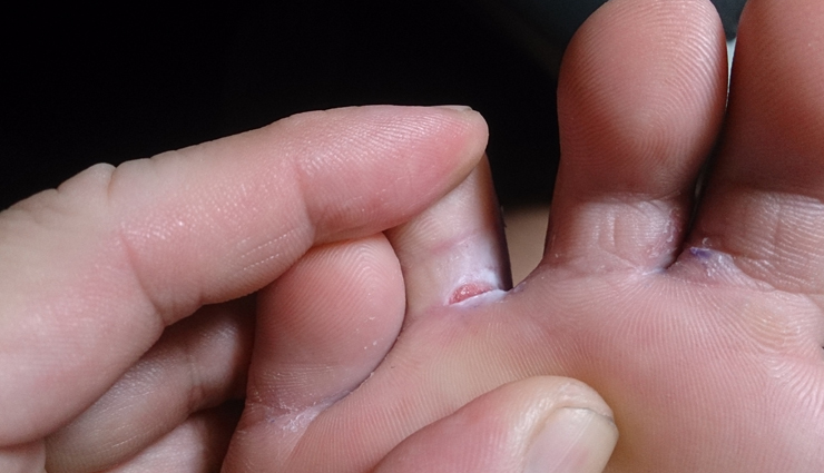 home remedies,home remedies to treat athletes foot,athletes foot remedies,Health tips,fitness tips,summer tips