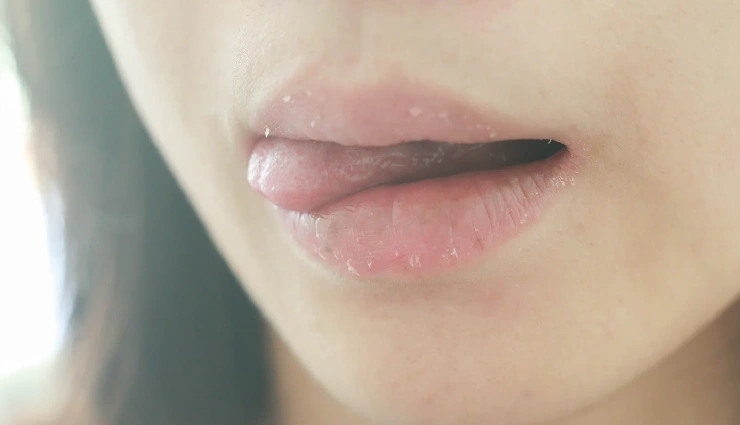 dry lips remedies,natural lip care,how to treat chapped lips,home remedies for cracked lips,causes of dry lips,soft lips tips,lip care without chemicals,best treatment for dry lips,natural cure for chapped lips,dry lip solutions