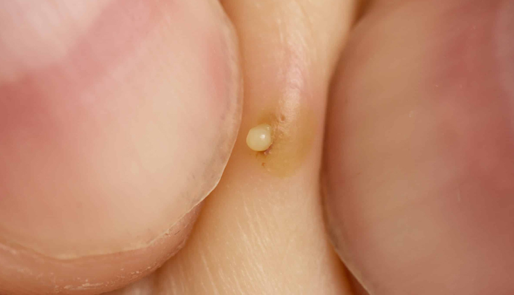 boils,natural way to treat boil,treat boil at home,boil treatment,home remedies to treat boil