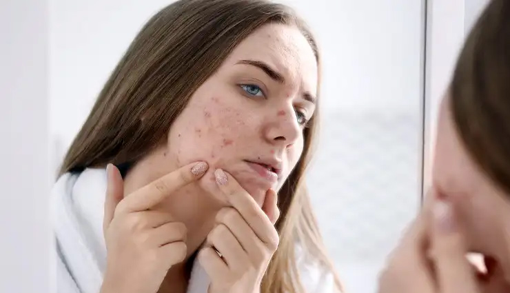 treat jawline acne,home remedies for jawline acne,acne on jawline treatment,prevent jawline acne,tips for jawline acne,hormonal acne remedies,acne-fighting ingredients,skincare for jawline acne,salicylic acid for acne,diet and acne prevention,avoid touching face for acne