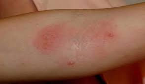 baaltod,home remedies