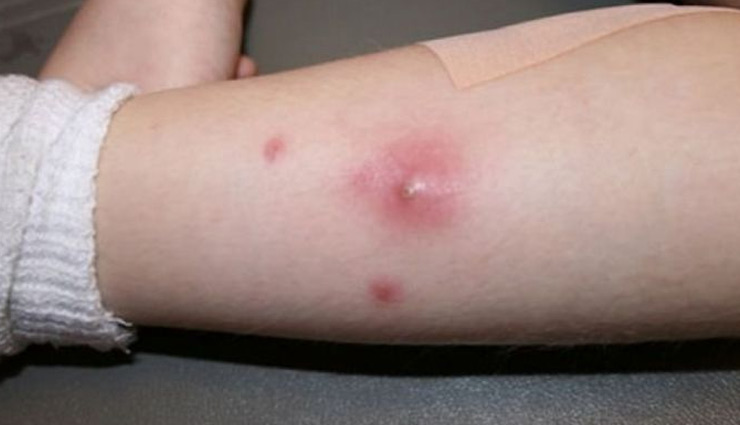 बालतोड़ की छोटी समस्या बन सकती है बहुत बड़ी, इन उपायों से जल्द करें इसका इलाज 