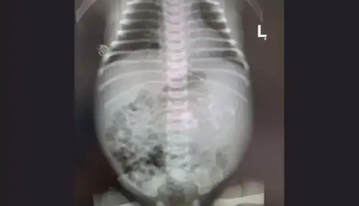 इजरायल : नवजात बच्ची के पेट में पल रहे थे एक से ज्यादा भ्रूण, हड्डियां और हार्ट हो चुके थे विकसित