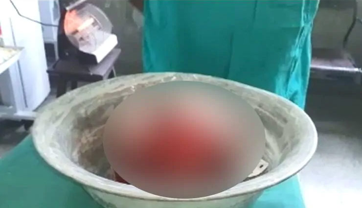 fetus,born out,stomach,6-month-old baby,patna,bihar,weird news