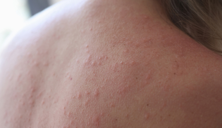 causes of rash on the back,back rash explanations,understanding back rash triggers,what causing my back rash?,back rash symptoms and causes,common reasons for back rash,identifying the rash on your back,treating rashes on the back,back rash diagnosis and treatment,managing back rash discomfort