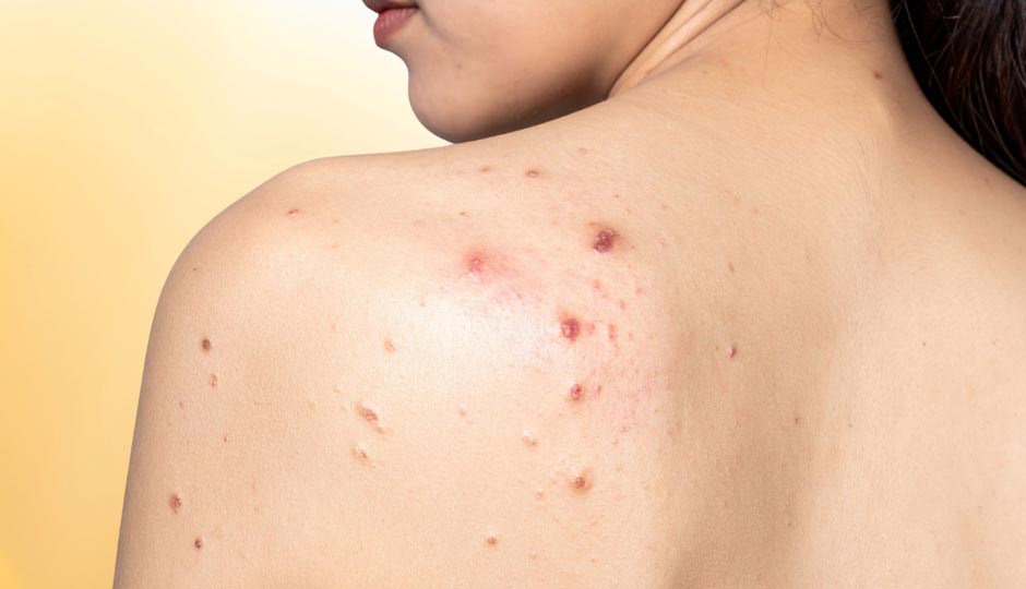 8 Home Remedies To Treat Back Acne