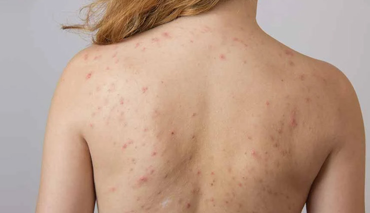 major causes of back acne,back acne,causes of acne,beauty tips,skin care tips