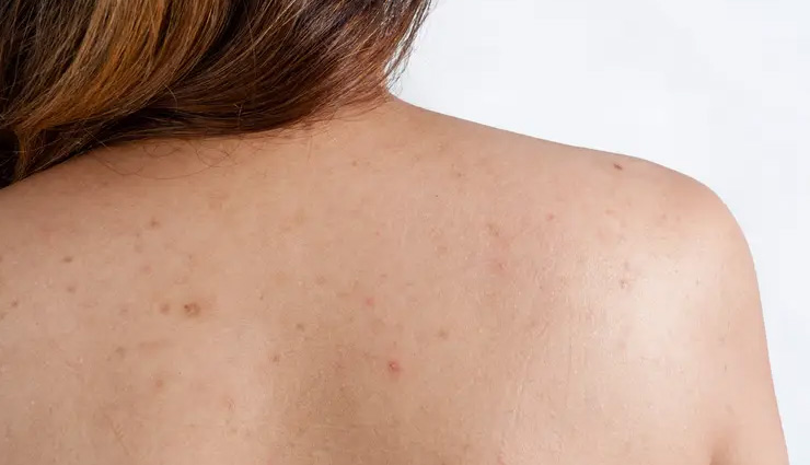 5 Major Causes of Back Acne You Must Be Aware About