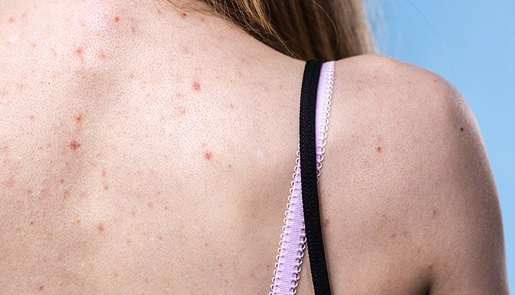 11 Ways To Treat Back Acne at Home