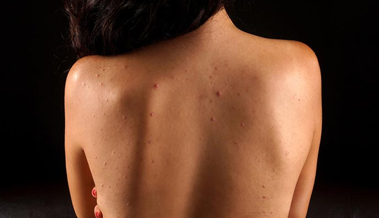 5 Quick Home Remedies To Treat Back Acne