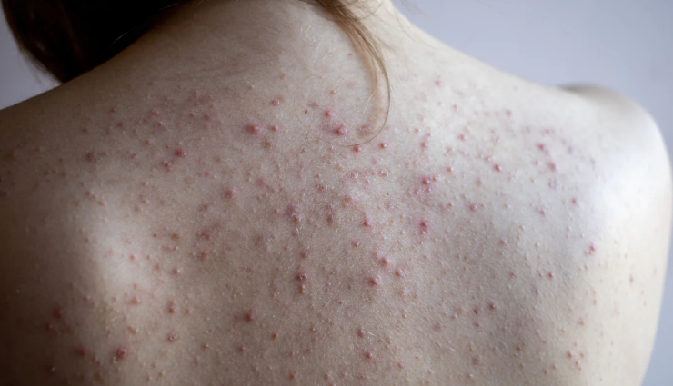 11 Must Try Home Remedies To Treat Back Acne