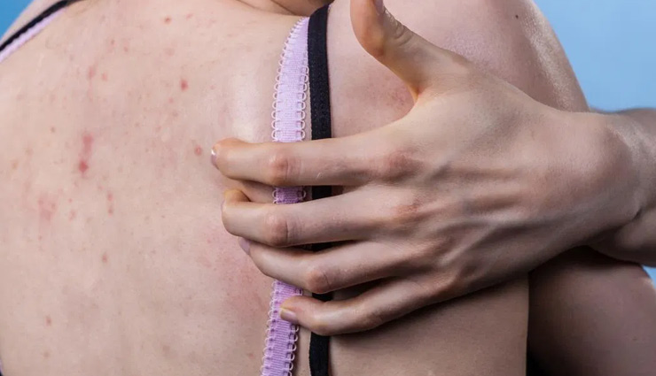 major causes of back acne,back acne,causes of acne,beauty tips,skin care tips