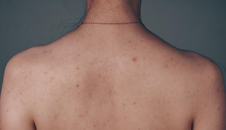 10 Effective Home Remedies to Get Rid of Back Acne Scars