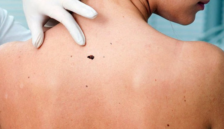 पीठ के मुंहासों से जल्द निजात पाए, इन उपायों की मदद से