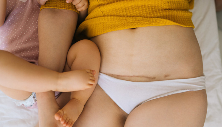 back pain post birth,remedies for back pain post birth,post birth tips,Health tips,fitness tips