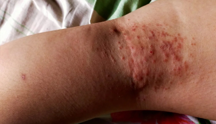 monsoon skin problems,skin issues during rainy season,common skin problems in monsoon,home remedies for monsoon skin problems,natural remedies for rainy season skin issues,getting rid of skin problems in the monsoon,monsoon skincare tips,treating skin problems during rainy season,monsoon skincare home remedies,healthy skin in the monsoon