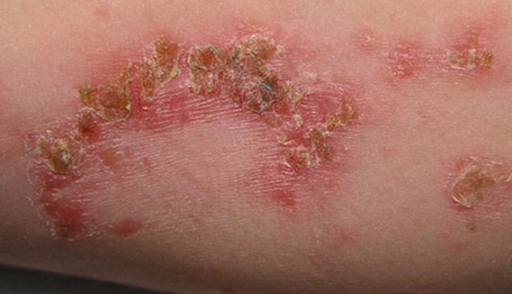 skin infection,bad habits for skin,skin health,skin care mistakes,prevent skin infection,skin hygiene,unhealthy skin habits,skin infection causes,protect skin from infection,skin wellness tips