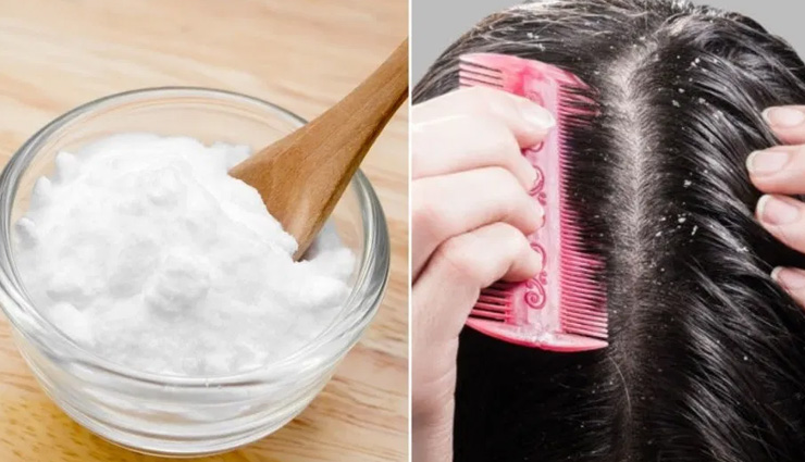 dandruff treatment,home remedies dandruff,scalp,dandruff treatment,dandruff funguss,beauty,beauty tips