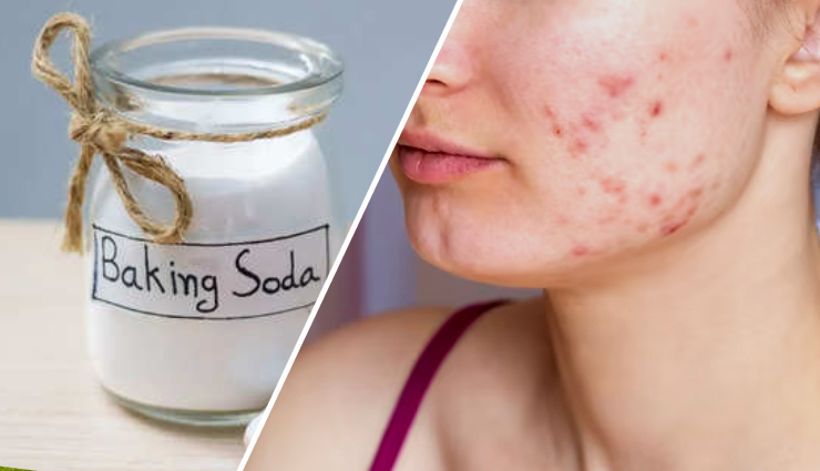 8 Reasons Why Baking Soda is Good for Treating Acne