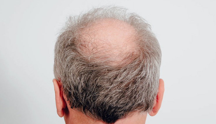 onion for hair growth,diy onion hair treatment,onion juice for hair,benefits of onion for hair,onion oil for hair,how to use onion for hair,onion hair mask,onion for hair loss,onion for dandruff,onion for scalp health,onion for hair thinning,natural hair remedies with onion,tips for using onion on hair,homemade onion hair products,onion for hair strengthening,onion for hair breakage