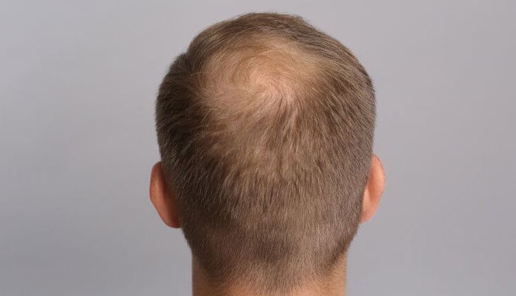 10 DIY Remedies To Grow Hair Back on Balding Forehead