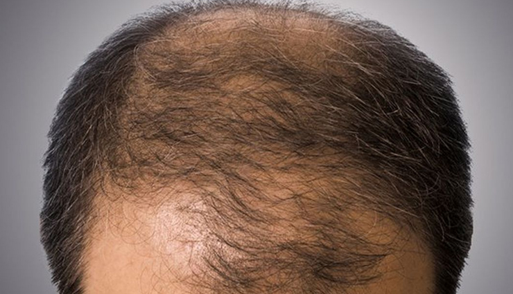 Home Remedies To Prevent Premature Baldness