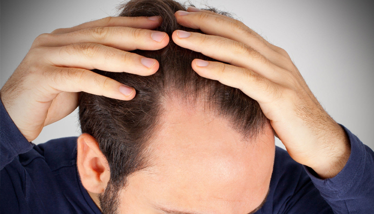 5 Inexpensive And Natural Treatment For Baldness