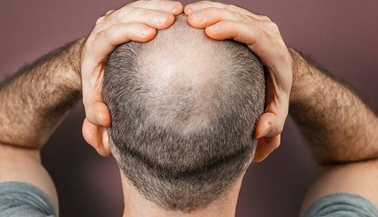 क्या आपके भी उड़ने लगे हैं बाल, इन 9 चीजों के इस्तेमाल से दूर करे गंजेपन की समस्या 