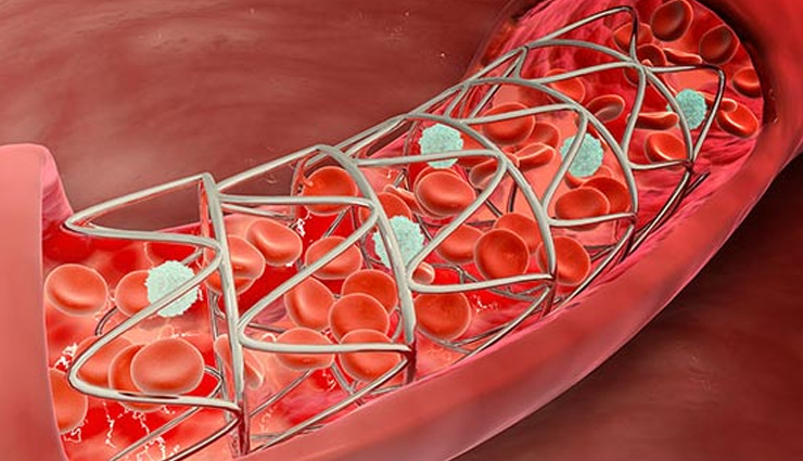 aortic stenosis,aortic valve narrowing,heart valve disease,aortic stenosis symptoms,causes of aortic stenosis,aortic stenosis diagnosis,aortic stenosis treatment,preventing aortic stenosis,aortic stenosis risk factors,aortic valve replacement
