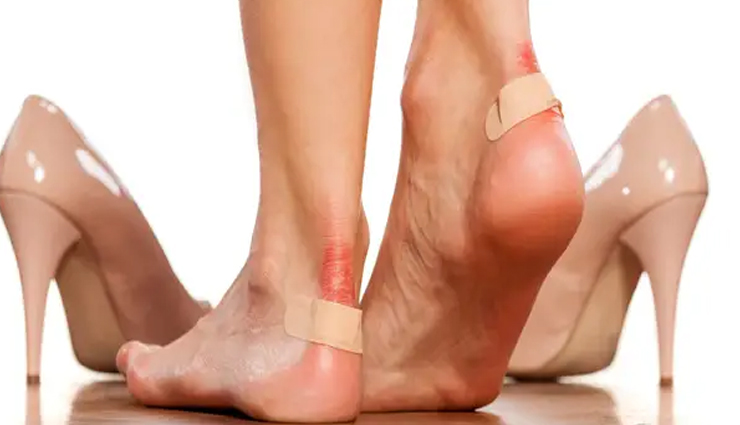 treating blisters,home remedies to treat blisters,healthy living,Health tips
