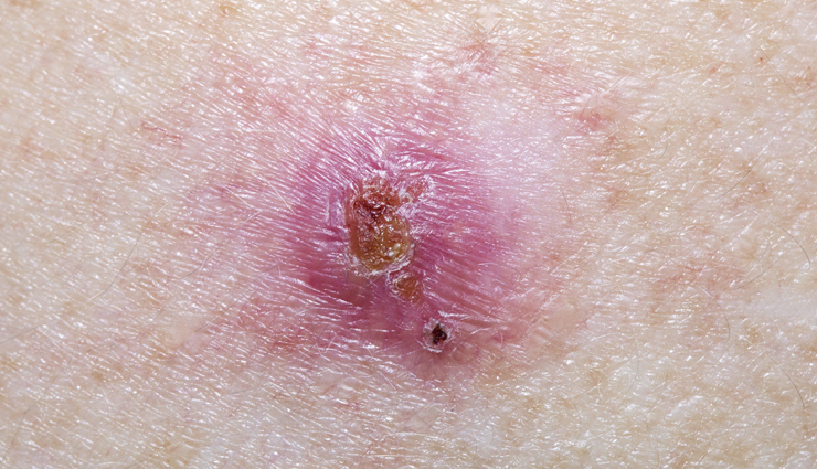 skin cancer symptoms,skin cancer types,skin cancer on face,skin cancer treatment,skin cancer on nose,skin cancer black skin,skin cancer by race,vitamin b skin cancer benefits,skin cancer color,skin cancer center,skin cancer cream,skin cancer color ribbon,vitamin c skin cancer treatment,vitamin c skin cancer prevention,skin cancer diagnosis,skin cancer detection,vitamin d skin cancer,vitamin d skin cancer treatment