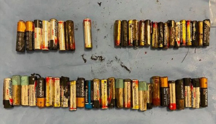 batteries,women swallow batteries,women swallow 55 batteries