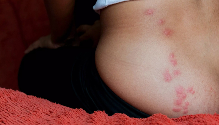 12 Remedies To Treat Bed Bug Bites at Home
