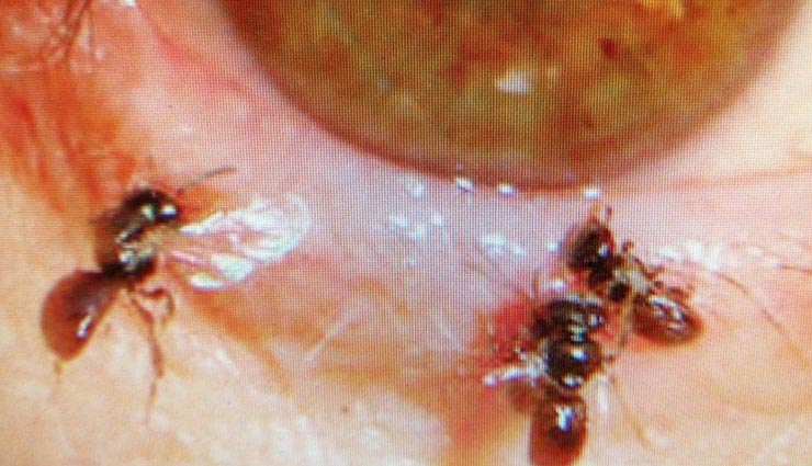 honey bees in eyes,eyes operation,weird case