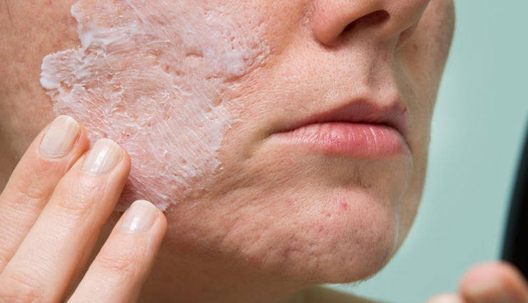 ways to get rid of blackheads,removing blackheads at home,blackheads treating tips,beauty tips,beauty hacks,skin care tips